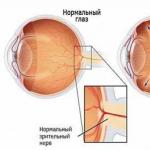 Причины и симптомы глаукомы — лечение и профилактика патологии зрения