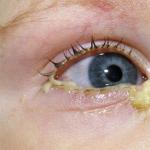 Причины гноящихся глаз у детей